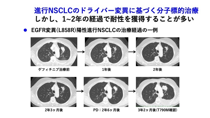 第59回日本癌治療学会レポート】進行非小細胞肺がんの分子標 | Medical Note Expert (メディカルノート エキスパート)