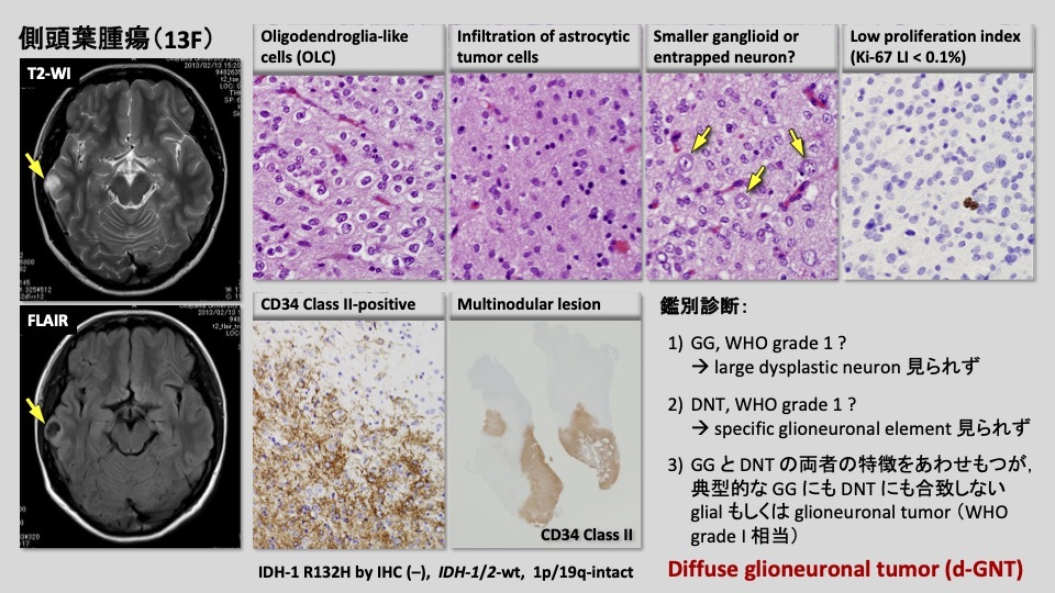 第55回日本てんかん学会レポート】組織診断はLEAT概念の | Medical