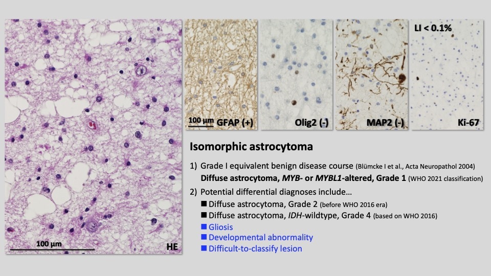 第55回日本てんかん学会レポート】組織診断はLEAT概念の | Medical