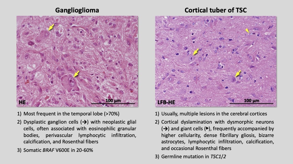 第55回日本てんかん学会レポート】組織診断はLEAT概念の | Medical