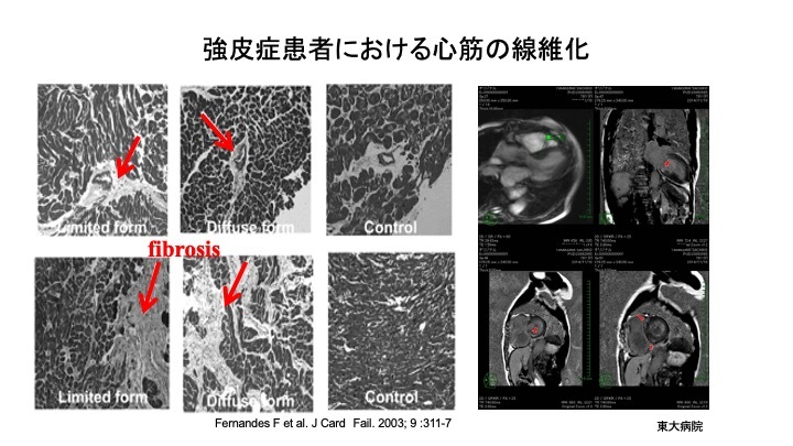 第7回日本肺高血圧・肺循環学会レポート】肺高血圧症治療の現 | Medical Note Expert (メディカルノート エキスパート)