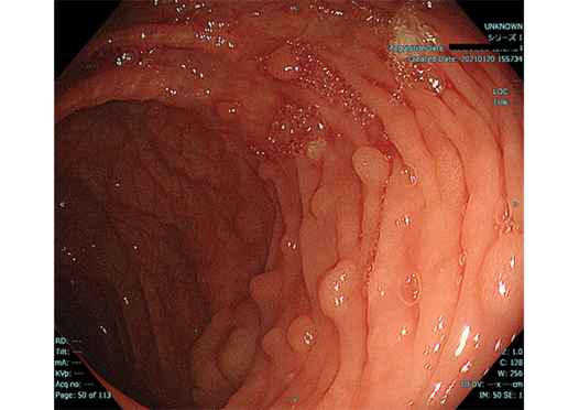 症例紹介】家族性大腸ポリポーシスに合併したステージIV大腸 | Medical Note Expert (メディカルノート エキスパート)
